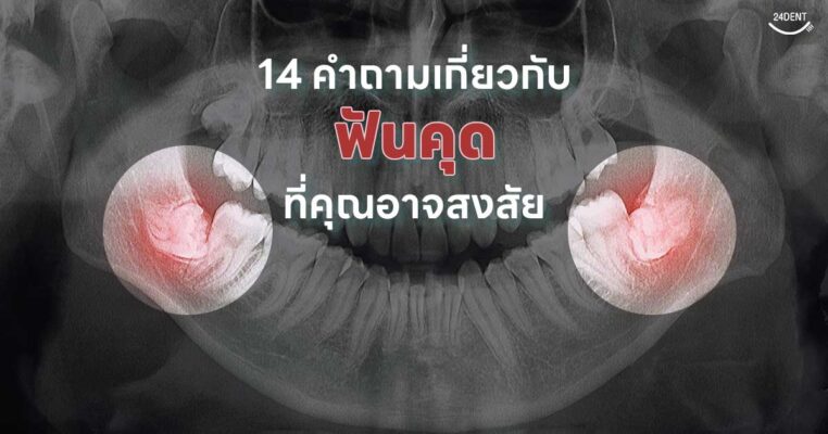 14 คำถามเกี่ยวกับฟันคุด